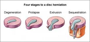Herniated/Prolapsed Intervertebral Disc