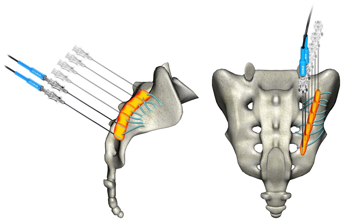 Interventional Pain therapies of Sacroiliac Joint