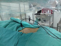 Disc Biacuplasty