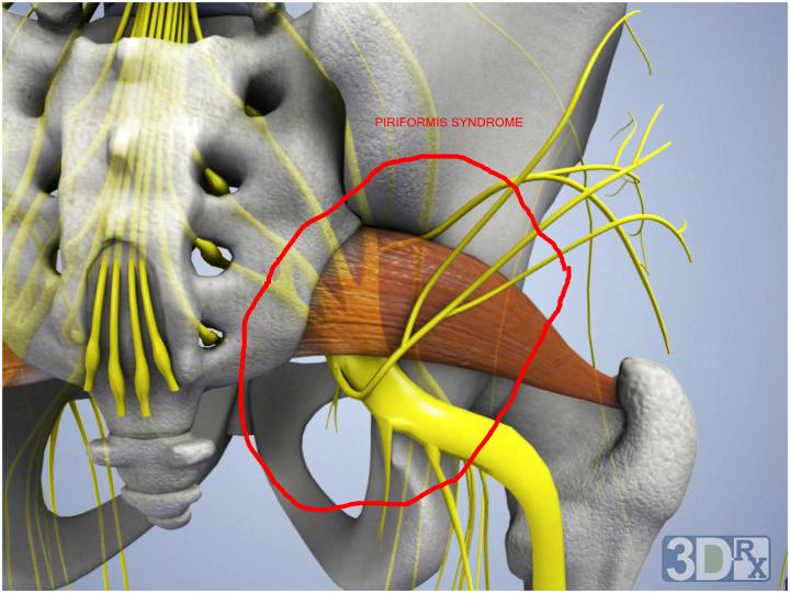 Piriformis Muscle Syndrome (PMS)