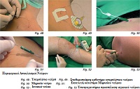 Continuous Peripheral Nerve Block (CPNB) with Catheter use