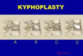 Vertebroplasty – Kyphoplasty