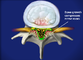 Spinal Stenosis
