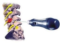 Percutaneous Intervertebral Disc Decompression