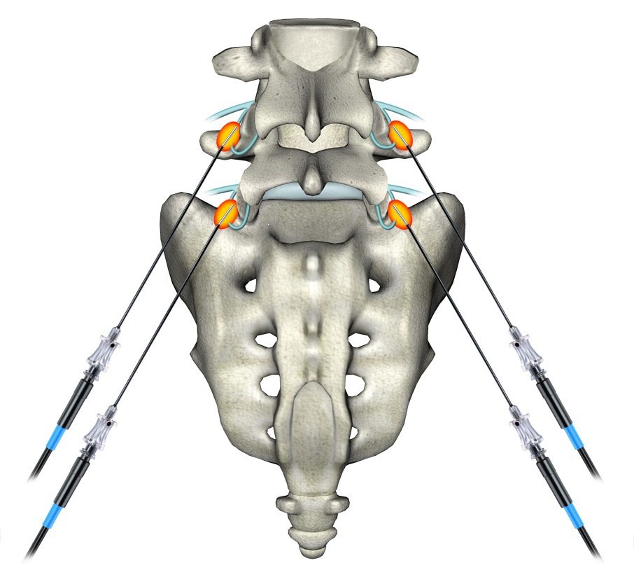 Radiofrequency Pain Treatment