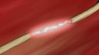 Post-traumatic and Post-operative Neuropathy