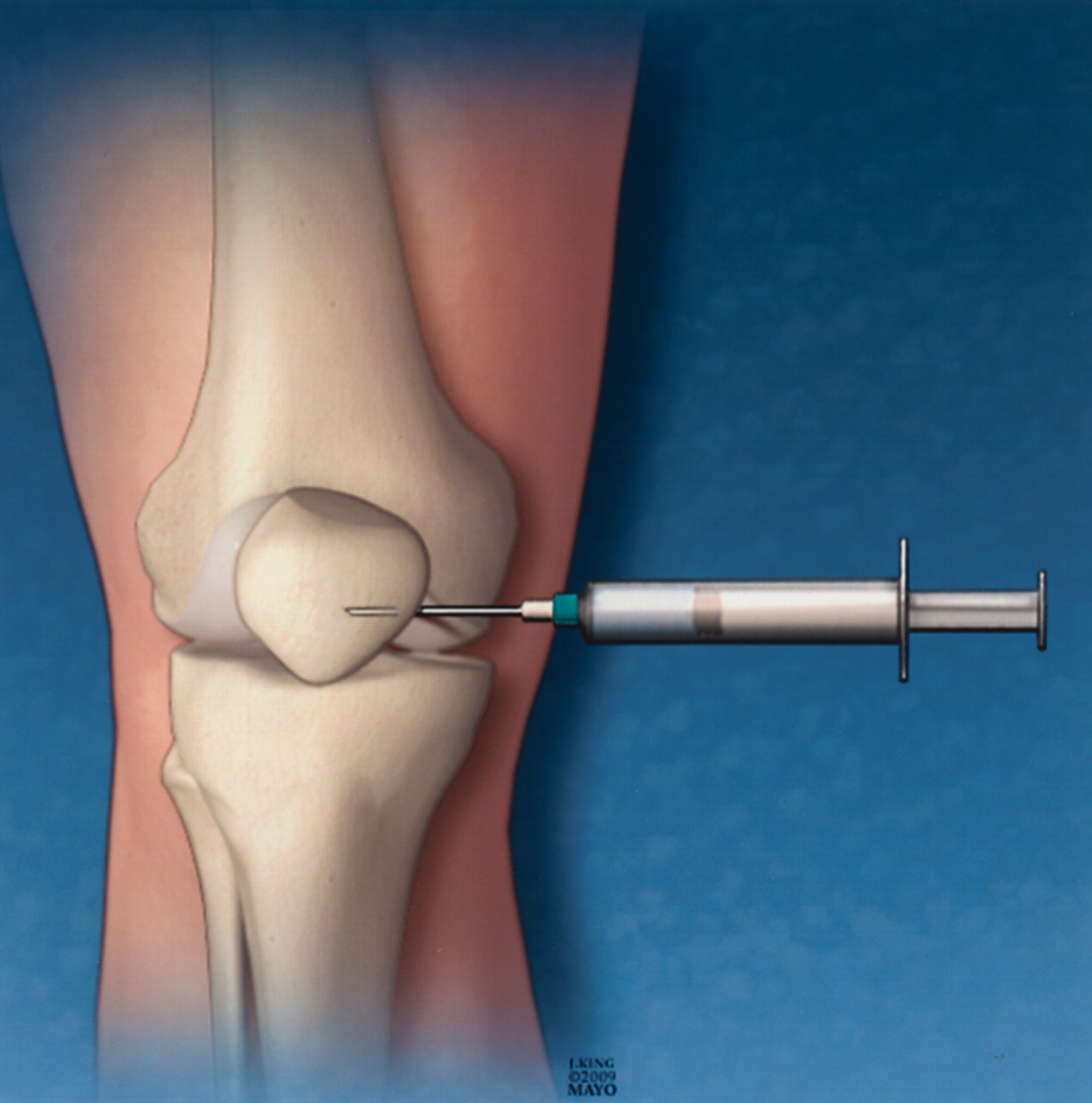 Intraarticular Injections