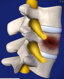 Metastatic Cancer
