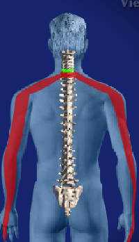 Cervical Radicular Pain