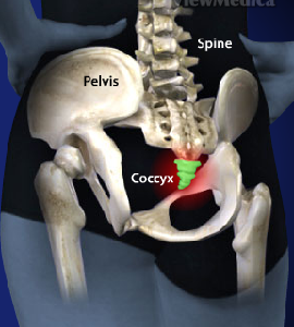 Coccygodynia
