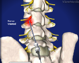 Radiofrequency Facet Joint Denervation