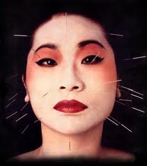 Acupuncture
