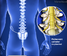 Intrathecal Pump Infusion