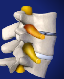 Lumbar Radicular Pain