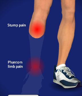 Phantom Limb Pain