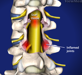 Failed Back Surgery Syndrome