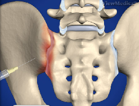 Sacroiliac Joint Injection