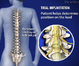 Spinal Cord Stimulation