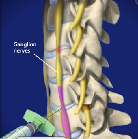 Stellate Ganglion Block