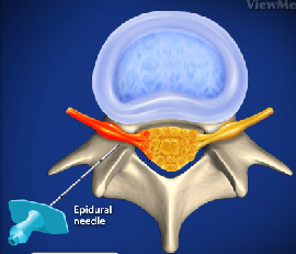 Lumbar Transforaminal Epidural Injection