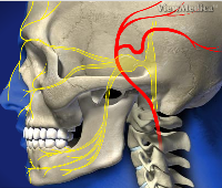 Trigeminal Neuralgia