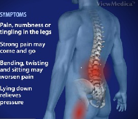 Disc Degenerative Disease