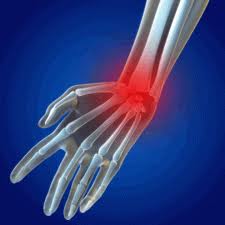 Carpal Tunnel Syndrome