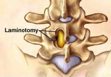 Micro-laminectomy and Μicro-hemilaminectomy