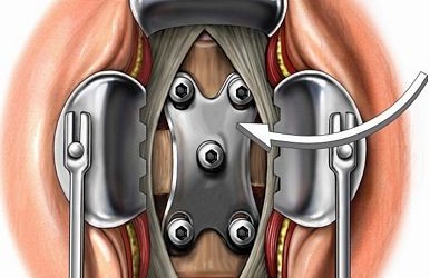 Minimally Invasive Techniques of Spine Fusion