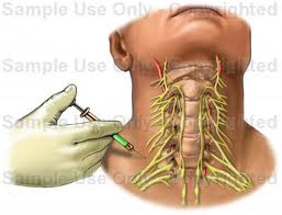 Stellate Ganglion Block