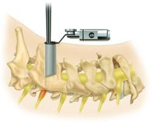 Microforaminotomy