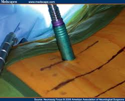 Microdiscectomy